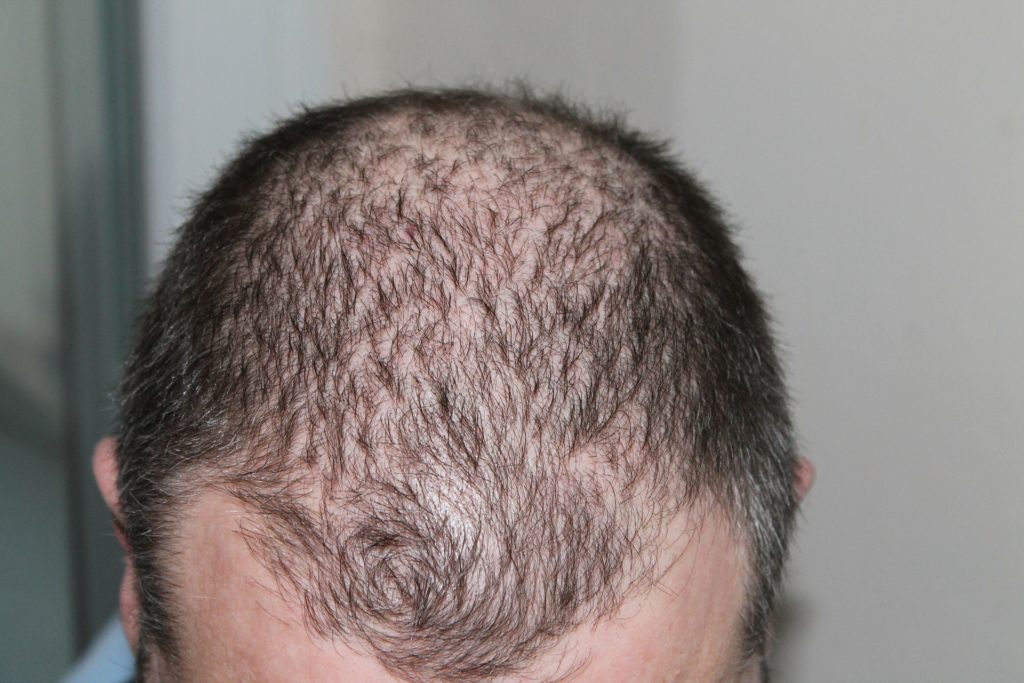 Best Tips And Advices On Hair Loss In Men