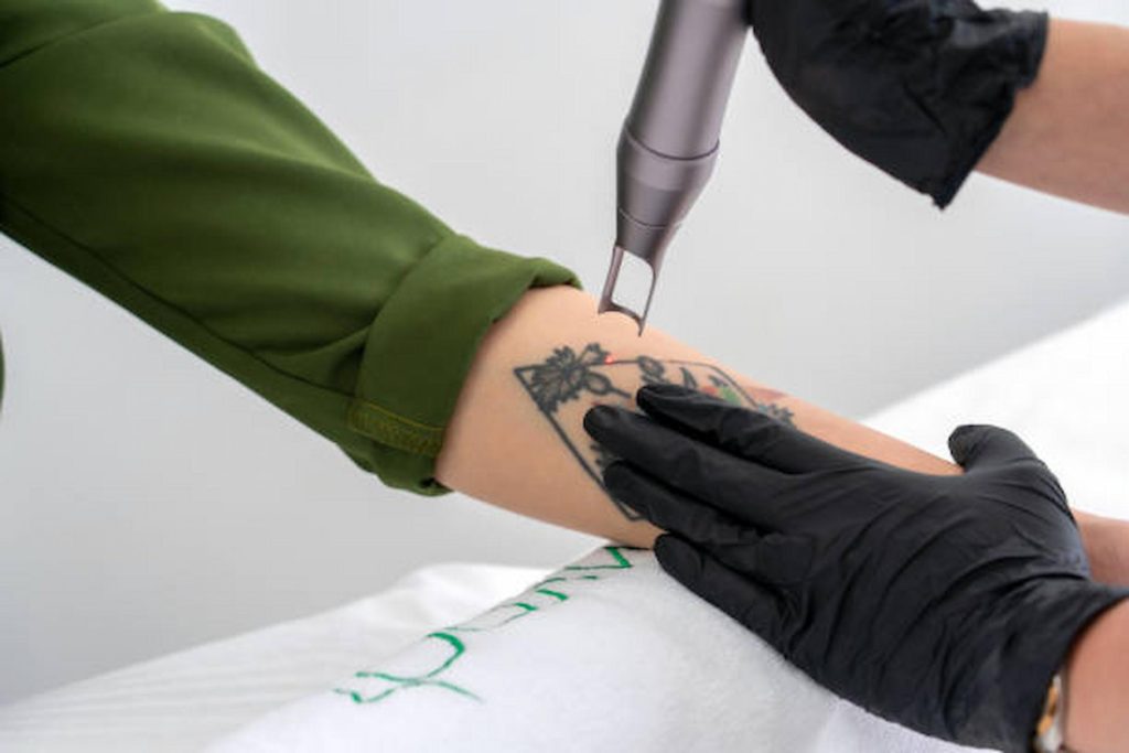 How Can You Find The Best Tattoo Removal Experts In London?